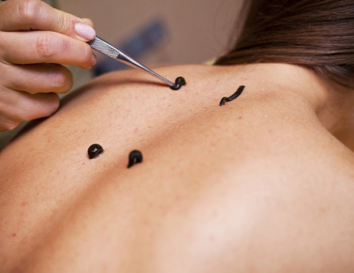 Гирудотерапия - Санаторий «Киев» Алушта